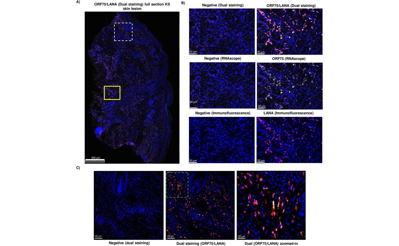 High Levels of Herpesvirus Gene in Kaposi Sarcoma Driven by DNA Sequence