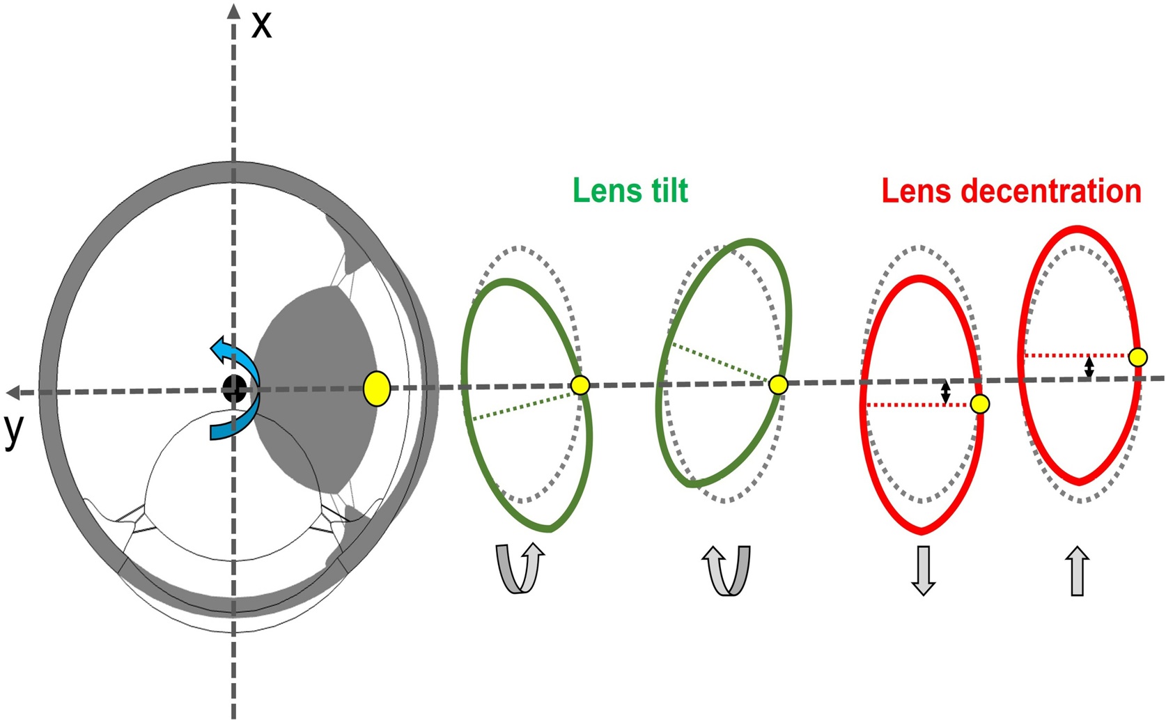 Eye Pressure Affects Lens Movements: A Computer Simulation Study