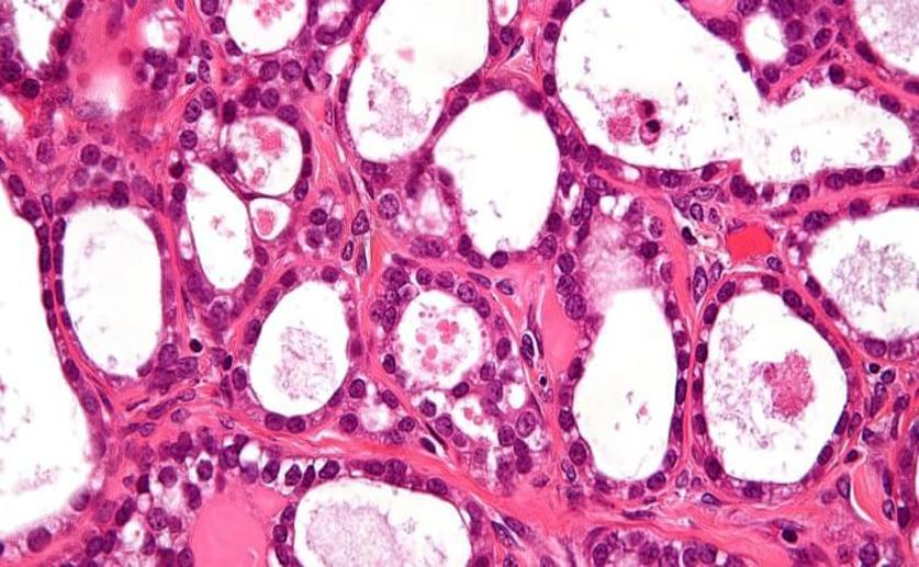 New DNA Tests Give More Accurate Information on Ovarian Cancer Progression